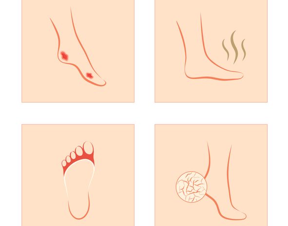 wounds